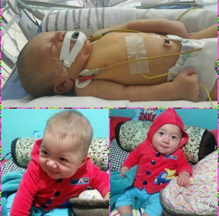 Sebas, un antes y un después de este bebé milagro