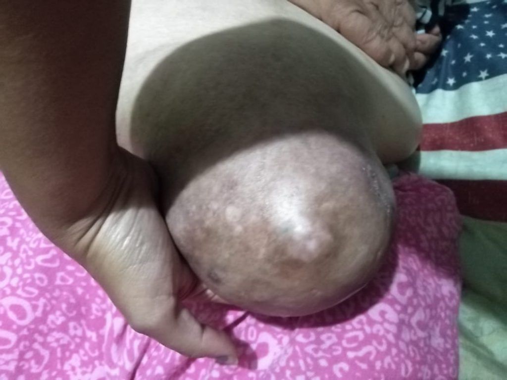 La hernia de doña Mayela ha sido operada pero vuelve a aparecer